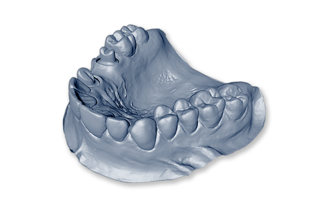 Jaw Impression For Dental Implants